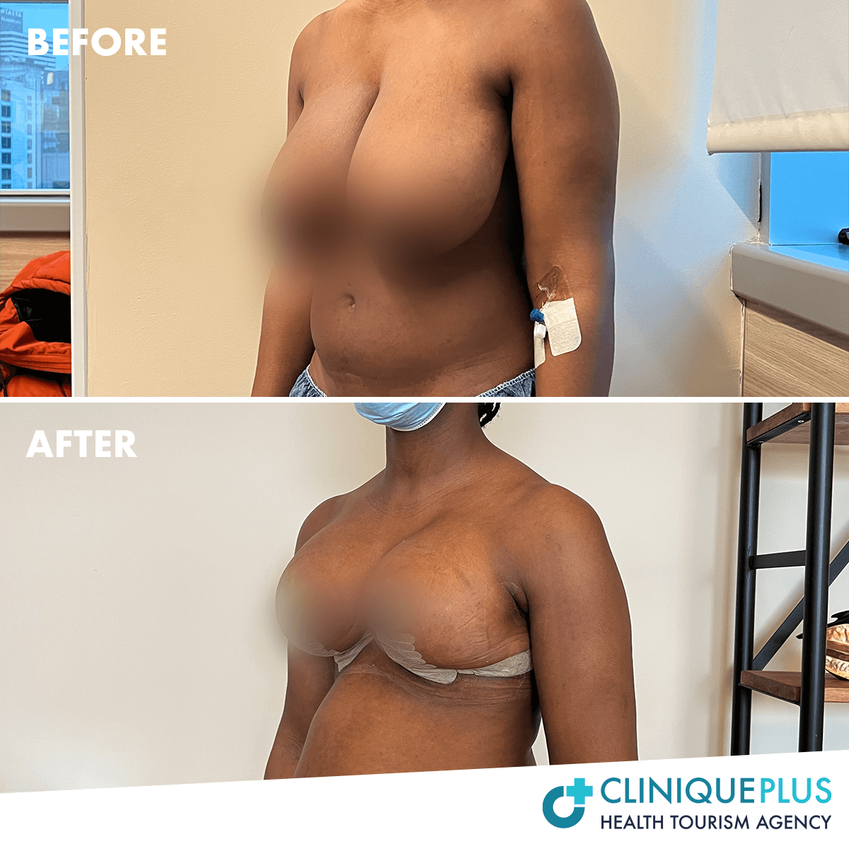 Bruststraffung vorher/nachher