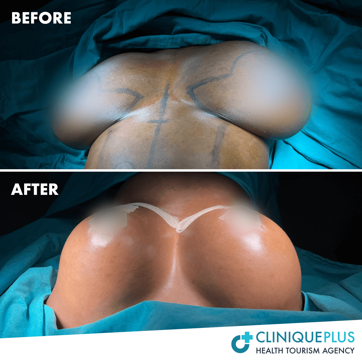 Bruststraffung vorher/nachher