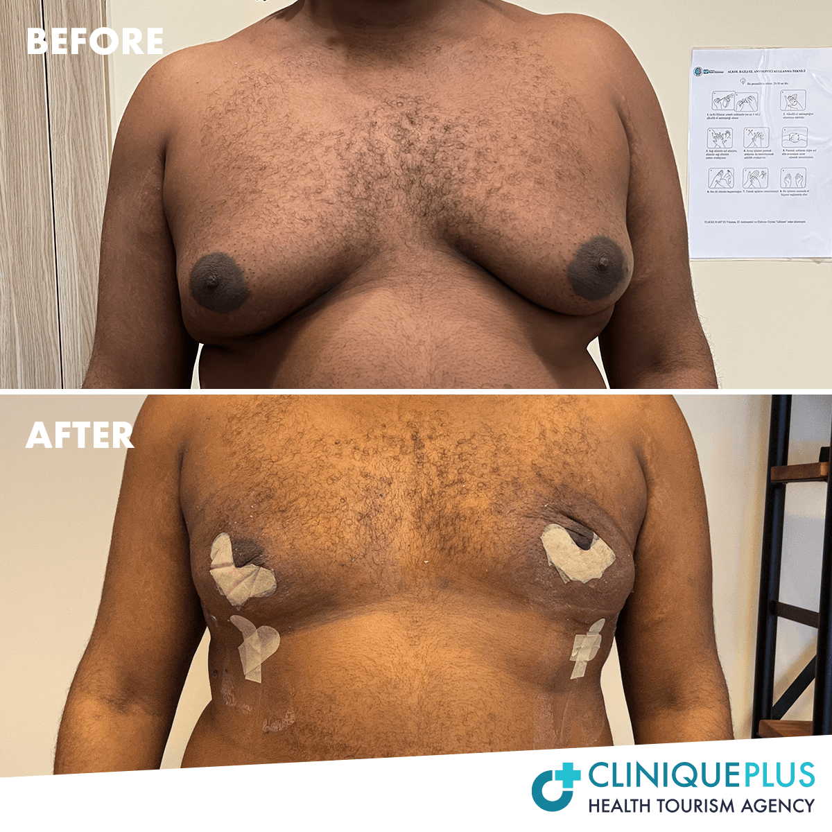 Brustverkleinerung VORHER/NACHHER