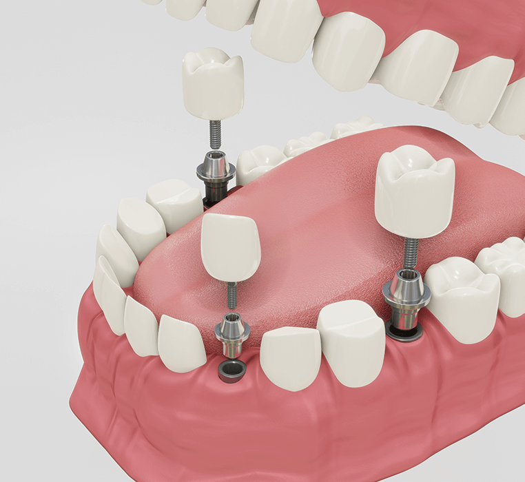 Dental Treatments