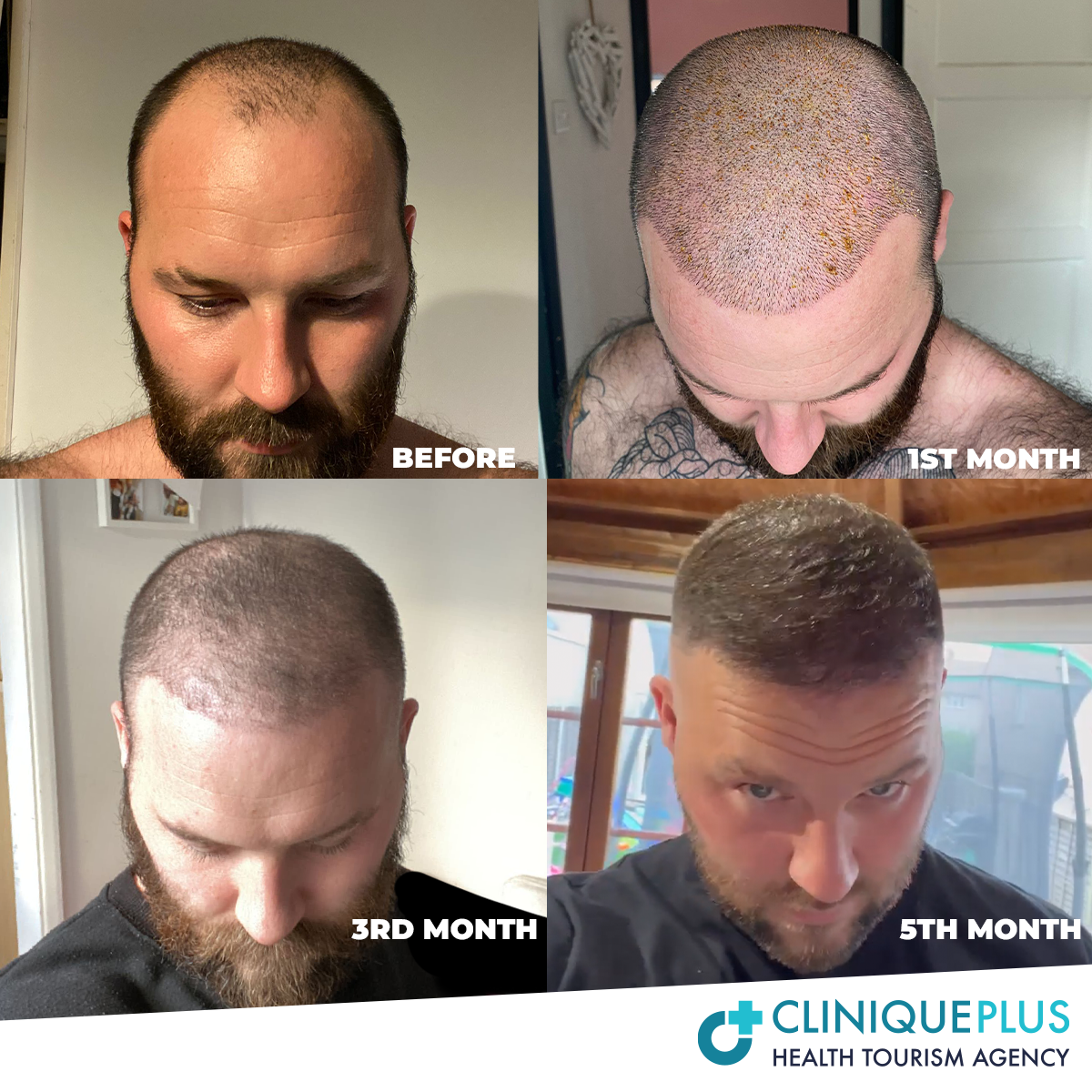 DHI Hair Transplantba2