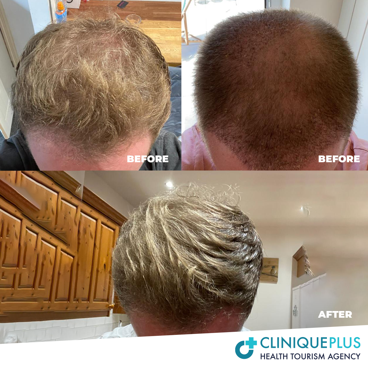 DHI Hair Transplantba4