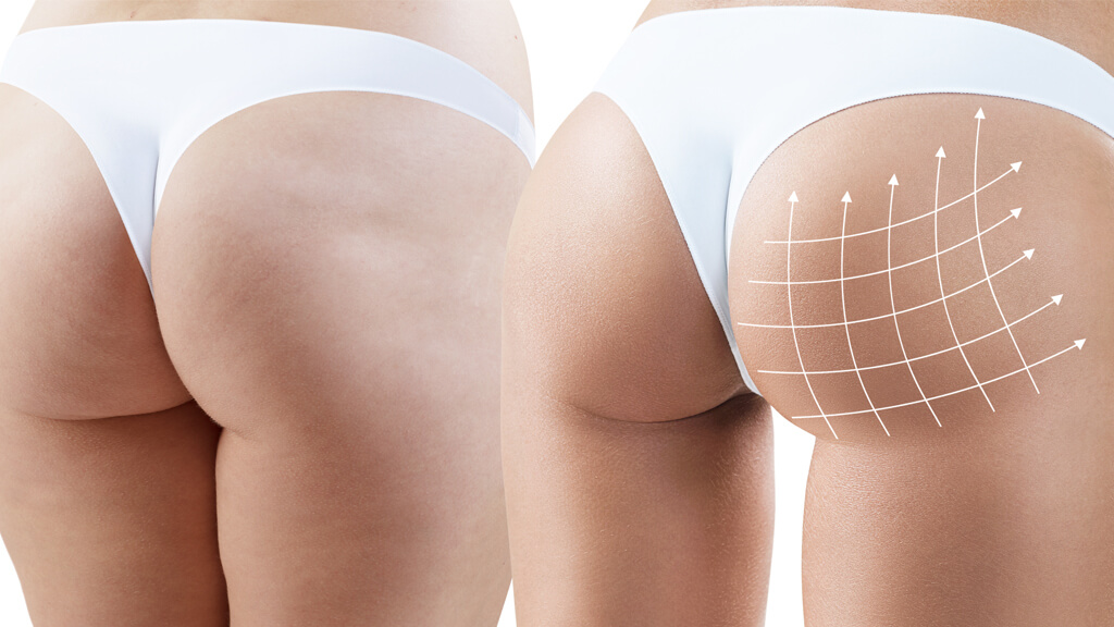 Brazilian Butt Lift Surgery 