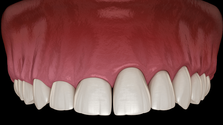 Gingivectomy: What You Need To Know?