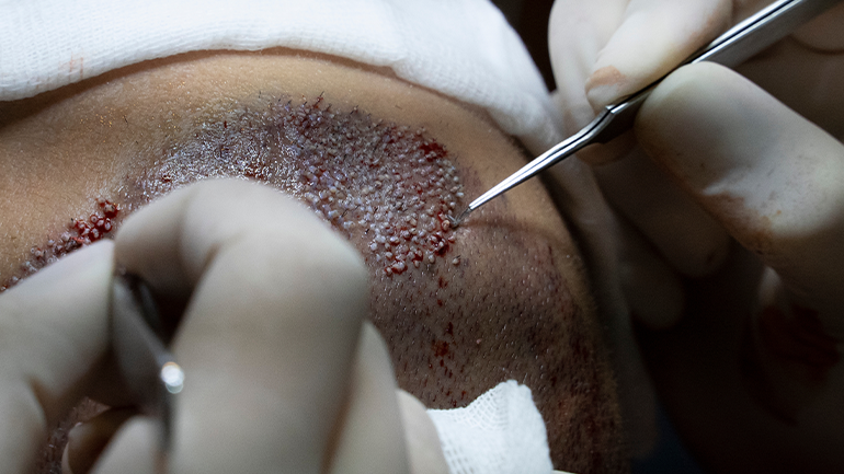 Shock Loss After Hair Transplant