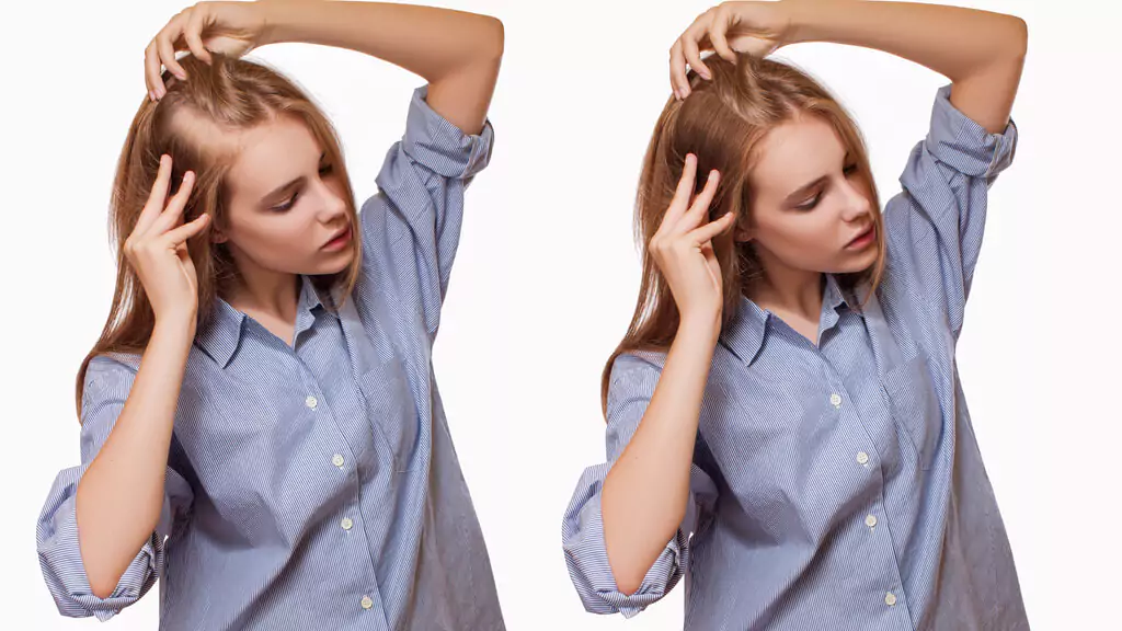 The Most Wondered Things About Post-Hair Transplantation Process