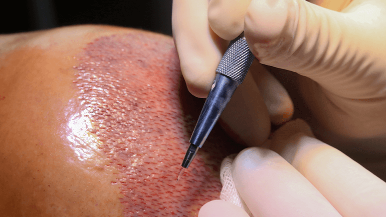 WHY IS SAPPHIRE FUE SO POPULAR?